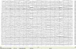 EEG-electroencefalograma-epilepsia