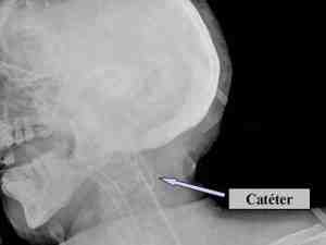 cateter-golfo-de-la-yugular-bucle