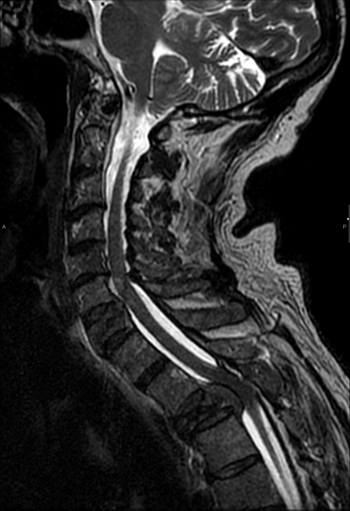 Compresión medular. Aplastamiento D3