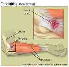 epicondilitis-codo-de-tenista