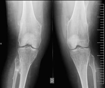exostosis-multiple-hereditaria