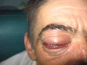 fistula-carotido-cavernosa