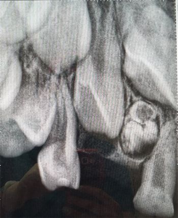 odontoma-compuesto-radiografia