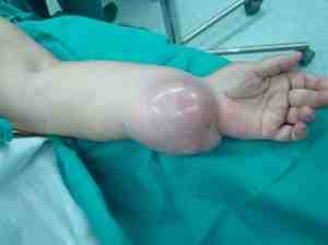 schwanoma-epitelioide-maligno-nervio-cubital