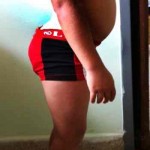 sindrome-Guillain-Barre