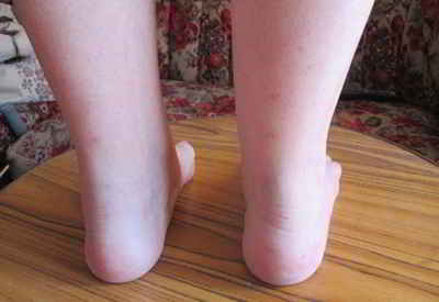 tendinitis-aquilea