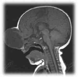 encefalocele-resonancia-magnetica-fetal