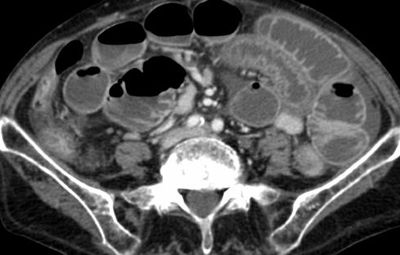 TAC-obstruccion-intestinal