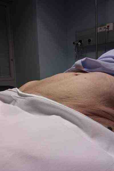 abdomen-tras-evacuacion-globo-vesical