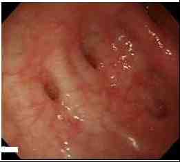 colonoscopia-diverticulos-colon-ascendente