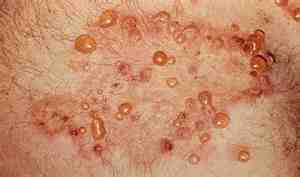 dermatitis-herpetiforme