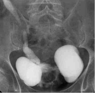 diverticulos-cistografia