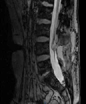 ependimoma-RMN