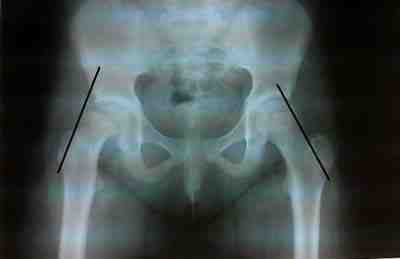 epifisiolisis-femoral-superior