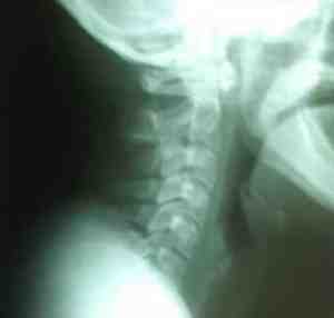 hernia-disco-cervical