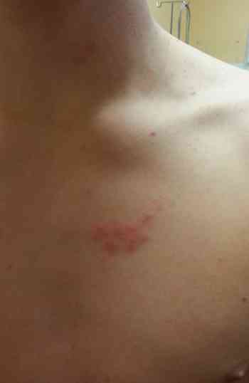 herpes-zoster-colitis-ulcerosa
