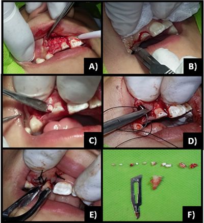odontoma-compuesto-cirugia