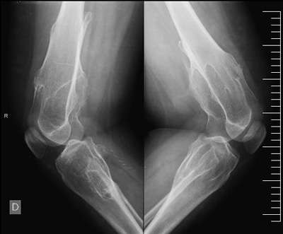 osteocondromas-multiples