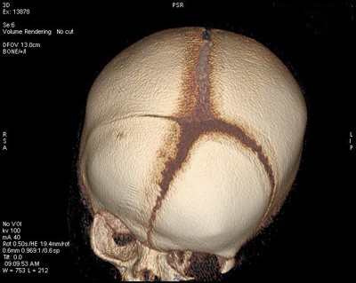 plagiocefalia-tc-3d-craneal
