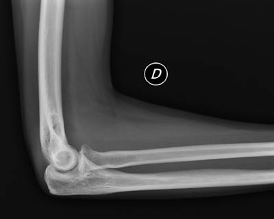 radiografia-codo