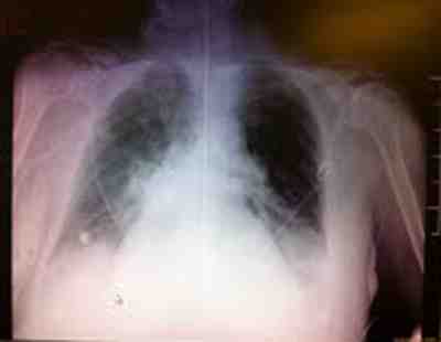 radiografia-torax-edema-agudo-pulmon