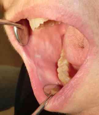 sindrome-ardor-bucal