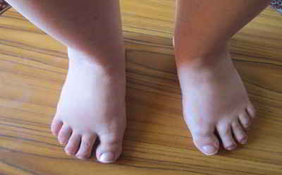 tendinitis-aquilea-exploracion