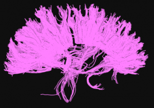 tractografia-cuerpo-calloso