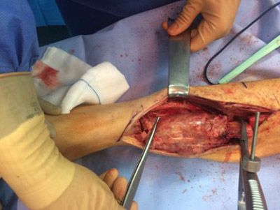 tumor-oseo-cirugia