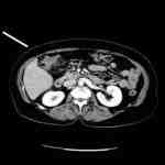 TAC-diverticulo-angulo-hepatico-colon