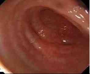 colonoscopia-mucosa-colonica-diverticulitis