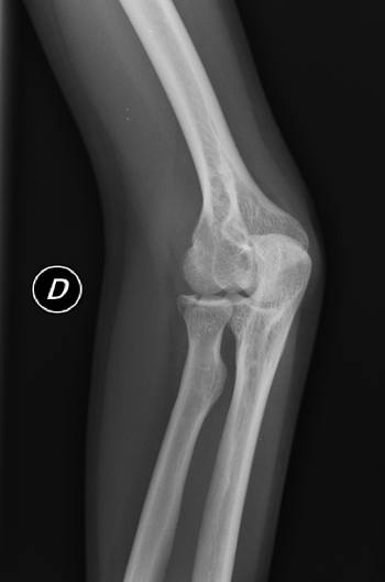 fractura-codo