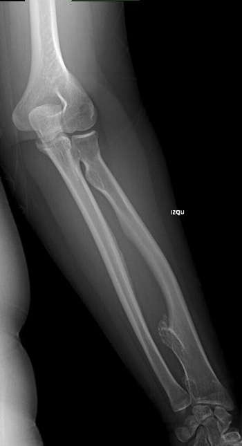 gonalgia-cronica