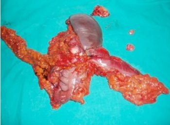 obstruccion-intestinal-cirugia