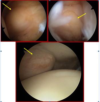 tumoracion-rodilla-artroscopia