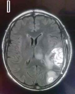 RMN-glioblastoma-cerebral