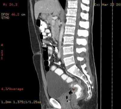 adenocarcinoma-rectal