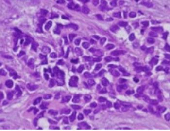 anatomia-patologica-tumor-desmoplasico