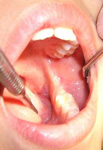 cicatrizacion-afta-bucal