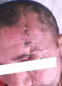 cicatrizacion-herida-quirurgica