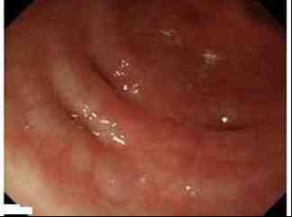 colonoscopia-mucosa-colonica-diverticulitis