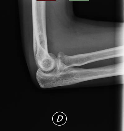 fractura-codo-radiografia