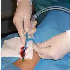 insercion-cateter-presion-intracraneal