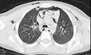 neumomediastino-anterior
