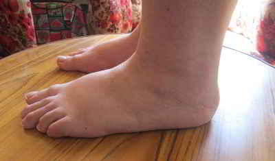 tendinitis-aquilea-caso-clinico