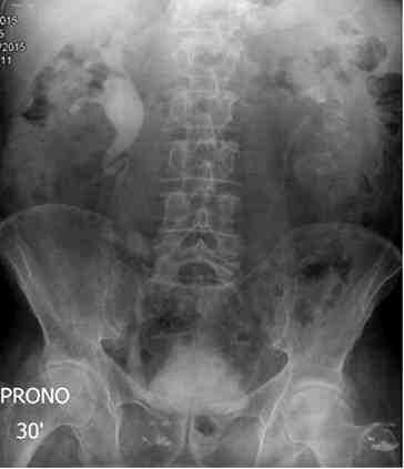 urografia-intravenosa