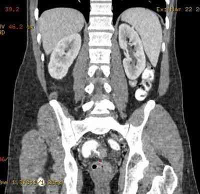 adenocarcinoma-recto