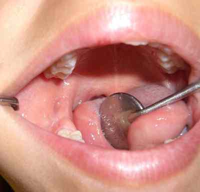 cicatrizacion-mucosa-bucal