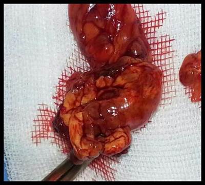 tumor-celulas-gigantes