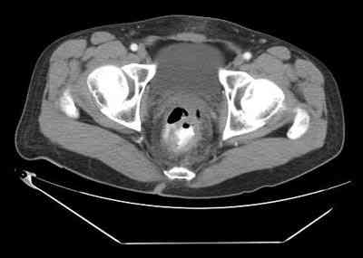 TAC-cancer-rectal